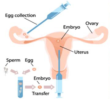 Intrauterine insemination in Andhra Pradesh,iui treatments in Andhra Pradesh,Intrauterine insemination treatments in Andhra Pradesh,Best Fertility Hospital In Andhra Pradesh,Best IVF Doctors In Andhra Pradesh,Best IVF centers In Andhra Pradesh,In Vitro Fertilization treatments in Andhra Pradesh,ivf treatments in Andhra Pradesh,ivf treatment in Andhra Pradesh,fertilization hospitals in Andhra Pradesh,In Vitro Fertilization, IVF Treatment in Andhra Pradesh,Best Infertility centers in Andhra Pradesh,Best Center for Human Reproduction,IVF and Reproductive Medicine,Fertility and Reproductive Medicine,ICSI and IVF for Male Infertility hospitals in Andhra Pradesh,Intracytoplasmic sperm injection treatments in Andhra Pradesh,ICSI Infertility Treatment in Andhra Pradesh,ICSI Treatment centers in Andhra Pradesh,gynaecology hospitals in Andhra Pradesh,gynaecology specialists in Andhra Pradesh,best gynaecology hospitals in Andhra Pradesh,obstetrics and gynaecology hospitals in Andhra Pradesh,Best obstetrics and gynaecology doctors in Andhra Pradesh,Vaginal Infections specialist in Andhra Pradesh,Pelvic Masses or Pelvic Tumor Treatment in Andhra Pradesh,gynaecology treatments in Andhra Pradesh,gynaecologist doctors in Andhra Pradesh,best Gynaecologist in Andhra Pradesh,Uterine Bleeding treatments in Andhra Pradesh,Best obstetric specialist in Andhra Pradesh,High pregnancy risk specialists in Andhra Pradesh,Polycystic Ovarian Disease treatments in Andhra Pradesh,Prenatal and Antepartum Care in Andhra Pradesh,Best Gynaecology Cesarean in Andhra Pradesh,Care for Pregnancy on Diabetes in Andhra Pradesh,Hypertension, pre-eclampsia and eclampsia treatments in Andhra Pradesh,Premature Rupture treatments in Andhra Pradesh,Post-term pregnancy care in Andhra Pradesh