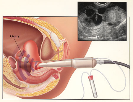 Intrauterine insemination in Andhra Pradesh,iui treatments in Andhra Pradesh,Intrauterine insemination treatments in Andhra Pradesh,Best Fertility Hospital In Andhra Pradesh,Best IVF Doctors In Andhra Pradesh,Best IVF centers In Andhra Pradesh,In Vitro Fertilization treatments in Andhra Pradesh,ivf treatments in Andhra Pradesh,ivf treatment in Andhra Pradesh,fertilization hospitals in Andhra Pradesh,In Vitro Fertilization, IVF Treatment in Andhra Pradesh,Best Infertility centers in Andhra Pradesh,Best Center for Human Reproduction,IVF and Reproductive Medicine,Fertility and Reproductive Medicine,ICSI and IVF for Male Infertility hospitals in Andhra Pradesh,Intracytoplasmic sperm injection treatments in Andhra Pradesh,ICSI Infertility Treatment in Andhra Pradesh,ICSI Treatment centers in Andhra Pradesh,gynaecology hospitals in Andhra Pradesh,gynaecology specialists in Andhra Pradesh,best gynaecology hospitals in Andhra Pradesh,obstetrics and gynaecology hospitals in Andhra Pradesh,Best obstetrics and gynaecology doctors in Andhra Pradesh,Vaginal Infections specialist in Andhra Pradesh,Pelvic Masses or Pelvic Tumor Treatment in Andhra Pradesh,gynaecology treatments in Andhra Pradesh,gynaecologist doctors in Andhra Pradesh,best Gynaecologist in Andhra Pradesh,Uterine Bleeding treatments in Andhra Pradesh,Best obstetric specialist in Andhra Pradesh,High pregnancy risk specialists in Andhra Pradesh,Polycystic Ovarian Disease treatments in Andhra Pradesh,Prenatal and Antepartum Care in Andhra Pradesh,Best Gynaecology Cesarean in Andhra Pradesh,Care for Pregnancy on Diabetes in Andhra Pradesh,Hypertension, pre-eclampsia and eclampsia treatments in Andhra Pradesh,Premature Rupture treatments in Andhra Pradesh,Post-term pregnancy care in Andhra Pradesh