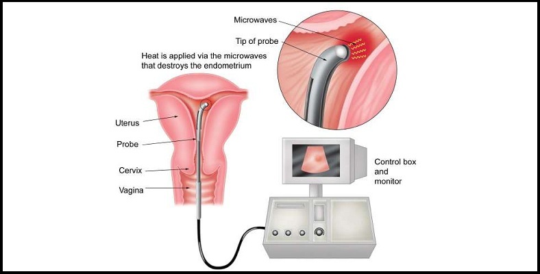 Intrauterine insemination in Andhra Pradesh,iui treatments in Andhra Pradesh,Intrauterine insemination treatments in Andhra Pradesh,Best Fertility Hospital In Andhra Pradesh,Best IVF Doctors In Andhra Pradesh,Best IVF centers In Andhra Pradesh,In Vitro Fertilization treatments in Andhra Pradesh,ivf treatments in Andhra Pradesh,ivf treatment in Andhra Pradesh,fertilization hospitals in Andhra Pradesh,In Vitro Fertilization, IVF Treatment in Andhra Pradesh,Best Infertility centers in Andhra Pradesh,Best Center for Human Reproduction,IVF and Reproductive Medicine,Fertility and Reproductive Medicine,ICSI and IVF for Male Infertility hospitals in Andhra Pradesh,Intracytoplasmic sperm injection treatments in Andhra Pradesh,ICSI Infertility Treatment in Andhra Pradesh,ICSI Treatment centers in Andhra Pradesh,gynaecology hospitals in Andhra Pradesh,gynaecology specialists in Andhra Pradesh,best gynaecology hospitals in Andhra Pradesh,obstetrics and gynaecology hospitals in Andhra Pradesh,Best obstetrics and gynaecology doctors in Andhra Pradesh,Vaginal Infections specialist in Andhra Pradesh,Pelvic Masses or Pelvic Tumor Treatment in Andhra Pradesh,gynaecology treatments in Andhra Pradesh,gynaecologist doctors in Andhra Pradesh,best Gynaecologist in Andhra Pradesh,Uterine Bleeding treatments in Andhra Pradesh,Best obstetric specialist in Andhra Pradesh,High pregnancy risk specialists in Andhra Pradesh,Polycystic Ovarian Disease treatments in Andhra Pradesh,Prenatal and Antepartum Care in Andhra Pradesh,Best Gynaecology Cesarean in Andhra Pradesh,Care for Pregnancy on Diabetes in Andhra Pradesh,Hypertension, pre-eclampsia and eclampsia treatments in Andhra Pradesh,Premature Rupture treatments in Andhra Pradesh,Post-term pregnancy care in Andhra Pradesh